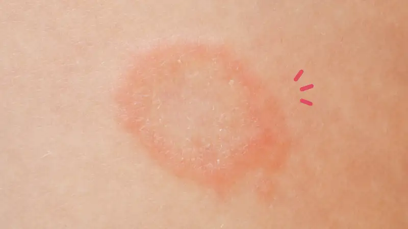 Ini Cara Lihat Perbedaan Gatal karena Alergi dan Jamur 3 Gatal Karena Jamur